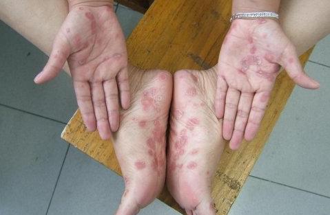 梅毒與艾滋病的關聯(lián)，深入了解疾病背后的真相，梅毒與艾滋病關聯(lián)揭秘，探究疾病背后的真相