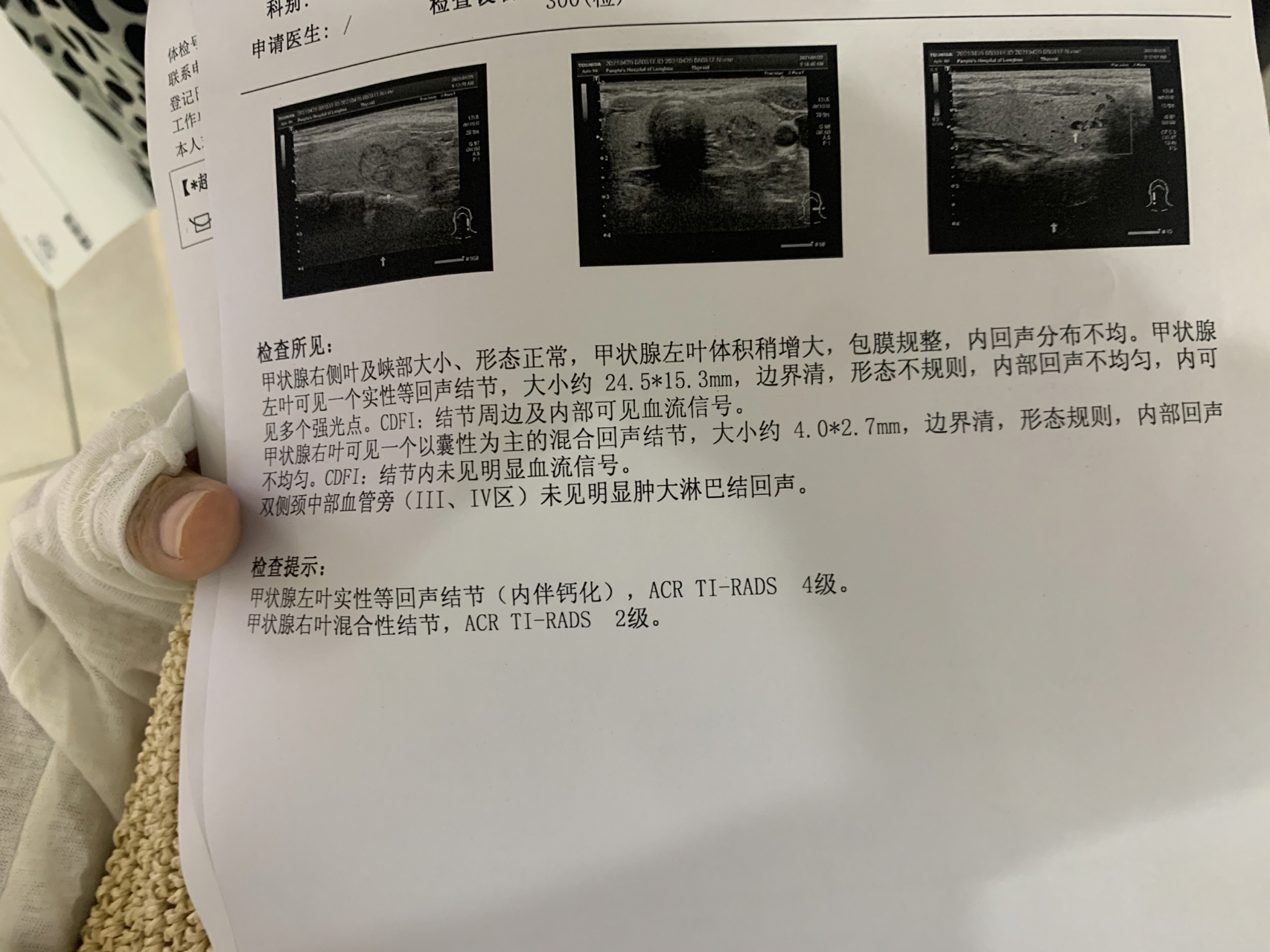 甲狀腺結(jié)節(jié)大小多少mm以上建議手術(shù)？全面解讀甲狀腺結(jié)節(jié)手術(shù)標(biāo)準(zhǔn)與注意事項(xiàng)，甲狀腺結(jié)節(jié)手術(shù)標(biāo)準(zhǔn)與注意事項(xiàng)，何時(shí)需手術(shù)？甲狀腺結(jié)節(jié)大小臨界點(diǎn)解析