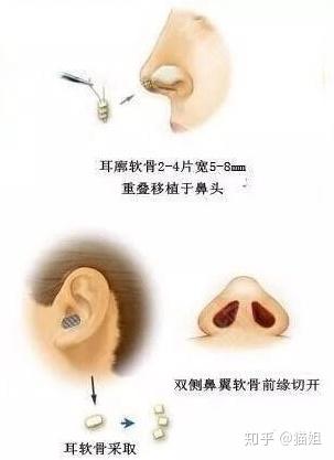 關(guān)于做一個耳軟骨隆鼻需要多少錢的全面解析，耳軟骨隆鼻手術(shù)費用全面解析，了解耳軟骨隆鼻所需費用